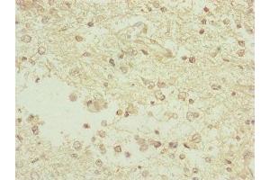 Immunohistochemistry of paraffin-embedded human glioma using ABIN7163117 at dilution of 1:100