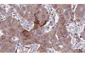 ABIN6276632 at 1/100 staining Human liver cancer tissue by IHC-P. (CD236/GYPC antibody  (Internal Region))