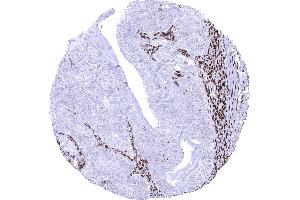 Ovary Malignant Mixed Mullerian tumor with strong MSH2 positivity in stromal and inflammatory cells but absence of staining in tumor cells (Recombinant MSH2 antibody)