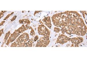 Immunohistochemistry of paraffin-embedded Human esophagus cancer tissue using E2F5 Polyclonal Antibody at dilution of 1:25(x200) (E2F5 antibody)