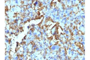 Formalin-fixed, paraffin-embedded human Histiocytoma stained with HLA-DR Monoclonal Antibody (LN-3 + HLA-DRB/1067). (HLA-DRB1 antibody)
