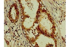 IHC image of ABIN7143827 diluted at 1:200 and staining in paraffin-embedded human breast cancer performed on a Leica BondTM system. (alpha Actinin 4 antibody  (AA 160-440))