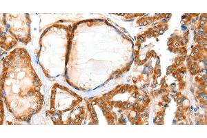 Immunohistochemistry of paraffin-embedded Human thyroid cancer tissue using ACOX1 Polyclonal Antibody at dilution 1:40 (ACOX1 antibody)