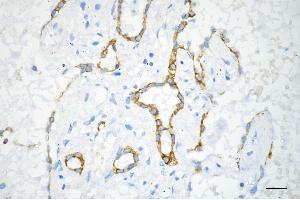 Immunohistochemistry was performed on paraffin-embedded human lung adenocarcinoma using EGFR antibody (ABIN7798480), 1:200). (Recombinant EGFR antibody)