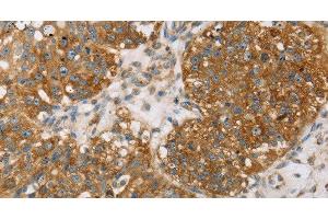 Immunohistochemistry of paraffin-embedded Human breast cancer using TPD54 Polyclonal Antibody at dilution of 1:35 (TPD52L2 antibody)