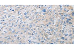 Immunohistochemistry of paraffin-embedded Human esophagus cancer using PDX1 Polyclonal Antibody at dilution of 1:30 (PDX1 antibody)