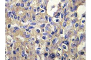 Immunohistochemical analysis of paraffin-embedded human liver carcinoma tissue using MELK polyclonal antibody . (MELK antibody)