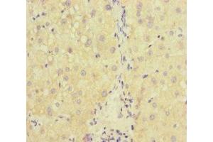 Immunohistochemistry of paraffin-embedded human liver cancer using ABIN7167234 at dilution of 1:100 (RAB18 antibody  (AA 1-206))