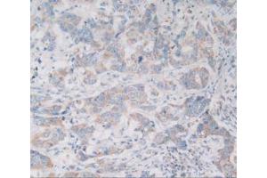 IHC-P analysis of Human Breast Cancer Tissue, with DAB staining. (VNN1 antibody  (AA 36-223))