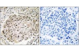 Immunohistochemistry analysis of paraffin-embedded human lung carcinoma, using USP36 Antibody. (USP36 antibody  (AA 501-550))