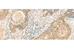 Immunohistochemistry of paraffin-embedded Human esophagus cancer tissue using NIP7 Polyclonal Antibody at dilution of 1:50(x200)