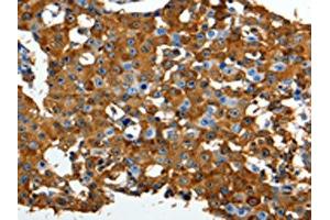 The image on the left is immunohistochemistry of paraffin-embedded Human breast cancer tissue using ABIN7191316(LRP1 Antibody) at dilution 1/90, on the right is treated with synthetic peptide. (LRP1 antibody)