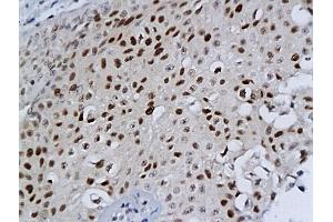 Formalin-fixed and paraffin embedded bladder cancer labeled with Anti-MCM-2 Polyclonal Antibody, Unconjugated (ABIN676238) at 1:200 followed by conjugation to the secondary antibody and DAB staining