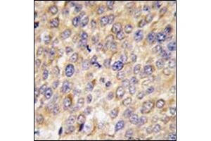 Formalin-Fixed, Paraffin-Embedded human hepatocarcinoma tissue reacted with Autophagy GABARAP Antibody (N-term) followed which was peroxidase-conjugated to the secondary antibody, followed by DAB staining.