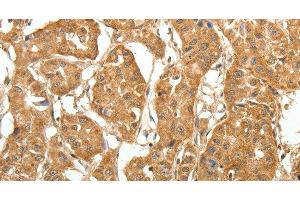 Immunohistochemistry of paraffin-embedded Human lung cancer tissue using MAP1B Polyclonal Antibody at dilution 1:60 (MAP1B antibody)