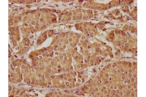IHC image of ABIN7157400 diluted at 1:300 and staining in paraffin-embedded human gastric cancer performed on a Leica BondTM system. (Keratin 2 antibody  (AA 207-424))