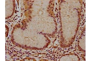 IHC image of ABIN7156557 diluted at 1:100 and staining in paraffin-embedded human gastric cancer performed on a Leica BondTM system. (IFNA16 antibody  (AA 24-189))