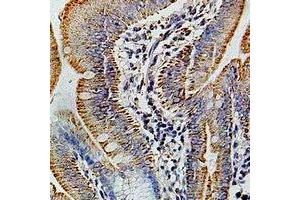 Immunohistochemical analysis of COX6B1 staining in human colon cancer formalin fixed paraffin embedded tissue section.