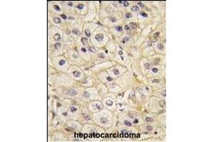 Formalin-fixed and paraffin-embedded human hepatocarcinoma tissue reacted with GRK1 Antibody (C-term) (ABIN390984 and ABIN2841167) , which was peroxidase-conjugated to the secondary antibody, followed by DAB staining. (GRK1 antibody  (C-Term))