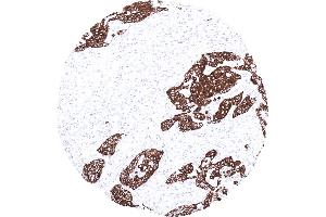 Strong cytokeratin 13 immunostaining in a squamous cell carcinoma of the oral cavity (Cytokeratin 13 antibody)