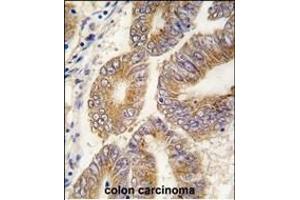 Formalin-fixed and paraffin-embedded human colon carcinoma tissue reacted with AHCY antibody (C-term) (ABIN389202 and ABIN2839362) , which was peroxidase-conjugated to the secondary antibody, followed by DAB staining. (AHCY antibody  (C-Term))