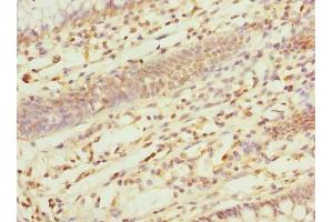 Immunohistochemistry of paraffin-embedded human colon cancer using ABIN7162554 at dilution of 1:100 (ZDHHC5 antibody  (AA 231-500))