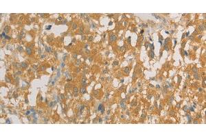 Immunohistochemistry of paraffin-embedded Human thyroid cancer tissue using PRPSAP1 Polyclonal Antibody at dilution 1:80 (PRPSAP1 antibody)