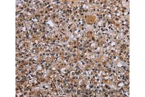Immunohistochemistry of Human prostate cancer using REL Polyclonal Antibody at dilution of 1:30 (c-Rel antibody)