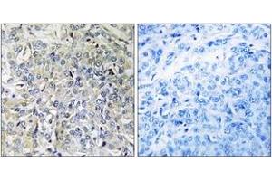 Immunohistochemistry analysis of paraffin-embedded human breast carcinoma tissue, using CSGALNACT2 Antibody. (CSGALNACT2 antibody  (AA 61-110))
