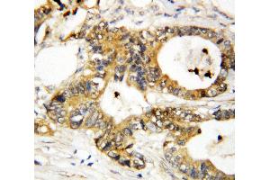 Anti-Annexin A3 antibody, IHC(P) IHC(P): Human Mammary Cancer Tissue (Annexin A3 antibody  (Middle Region))
