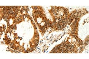 Immunohistochemistry of paraffin-embedded Human colon cancer using COX7B Polyclonal Antibody at dilution of 1:60 (COX7B antibody)