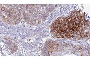 ABIN6279126 at 1/100 staining Human urothelial cancer tissue by IHC-P. (SLC4A2 antibody  (Internal Region))