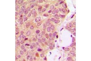 Immunohistochemical analysis of OMI staining in human breast cancer formalin fixed paraffin embedded tissue section. (HTRA2 antibody)