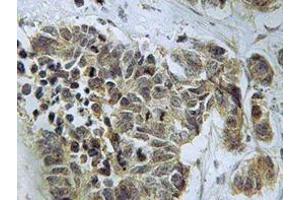 Immunohistochemistry analyzes of Caspase 9 antibody in paraffin-embedded human lung carcinoma tissue. (Caspase 9 antibody)