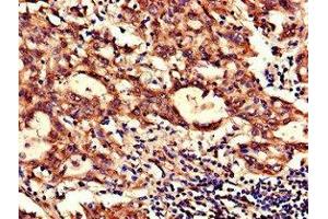 Immunohistochemistry of paraffin-embedded human lung cancer using ABIN7160929 at dilution of 1:100 (NDUFB6 antibody  (AA 2-67))