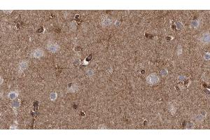 ABIN6272633 at 1/100 staining Human brain cancer tissue by IHC-P.