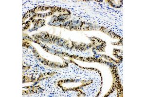 Anti-DUT antibody,  IHC(P) IHC(P): Human Intestinal Cancer Tissue (Deoxyuridine Triphosphatase (DUT) (AA 212-229), (C-Term) antibody)