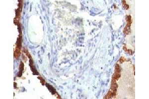 Formalin-fixed, paraffin-embedded human lung carcinoma stained with Cytokeratin 7 antibody (KRT7/760)