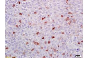 Formalin-fixed and paraffin embedded human lung carcinoma labeled with Anti-ATF1 Polyclonal Antibody, Unconjugated (ABIN669531) at 1:200 followed by conjugation to the secondary antibody and DAB staining. (AFT1 antibody  (AA 201-271))