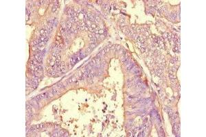 Immunohistochemistry of paraffin-embedded human endometrial cancer using ABIN7143790 at dilution of 1:100 (alpha 2 Macroglobulin antibody  (AA 1216-1467))