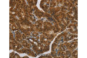 Immunohistochemistry of Human breast cancer using MRE11A Polyclonal Antibody at dilution of 1:60