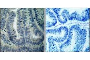 Immunohistochemistry analysis of paraffin-embedded human colon carcinoma tissue, using BAD (Ab-112) Antibody. (BAD antibody  (AA 78-127))