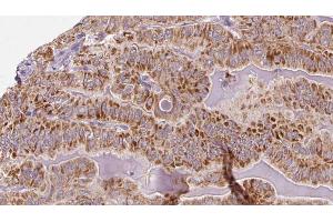 ABIN6273318 at 1/100 staining Human thyroid cancer tissue by IHC-P. (SHMT1 antibody  (Internal Region))