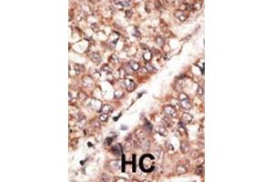 Formalin-fixed and paraffin-embedded human cancer tissue reacted with the primary antibody, which was peroxidase-conjugated to the secondary antibody, followed by AEC staining. (BMP3 antibody  (N-Term))