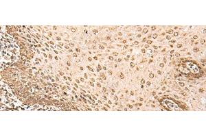 Immunohistochemistry of paraffin-embedded Human esophagus cancer tissue using BAP1 Polyclonal Antibody at dilution of 1:35(x200) (BAP1 antibody)