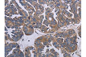 The image on the left is immunohistochemistry of paraffin-embedded Human ovarian cancer tissue using ABIN7191790(PARP4 Antibody) at dilution 1/20, on the right is treated with synthetic peptide. (PARP4 antibody)