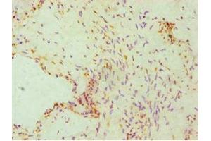 Immunohistochemistry of paraffin-embedded human cervical cancer using ABIN7162842 at dilution of 1:100 (FKBP4 antibody  (AA 220-459))