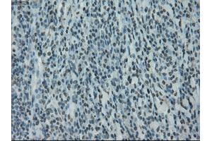Immunohistochemical staining of paraffin-embedded Carcinoma of bladder tissue using anti-PRKYmouse monoclonal antibody. (PRKY antibody)