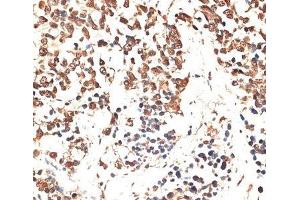 Immunohistochemistry of paraffin-embedded Human lung cancer using MCM5 Polyclonal Antibody at dilution of 1:100 (40x lens). (MCM5 antibody)