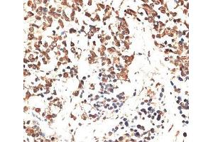 Immunohistochemistry of paraffin-embedded Human lung cancer using MCM5 Polyclonal Antibody at dilution of 1:100 (40x lens). (MCM5 antibody)